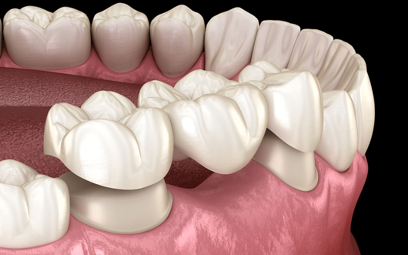 Understanding Dental Bridges And Crowns: A Guide By General Dentists