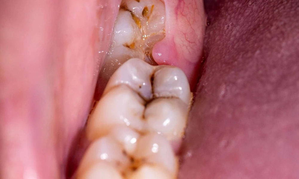 Everything You Need to Know About Wisdom Tooth Removal